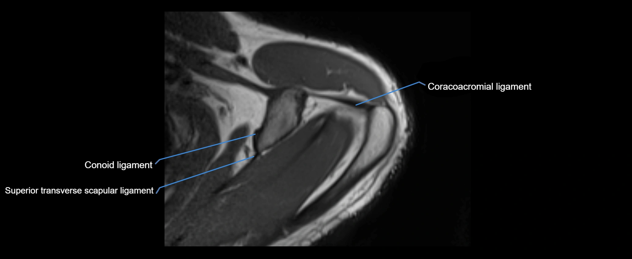 shoulder ligaments axial 3d 3t mri image-img-00005-00033.webp